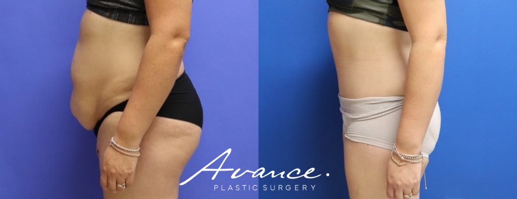 Before and After - Abdominoplasty