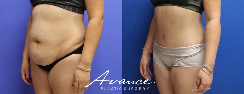Before and After - Abdominoplasty
