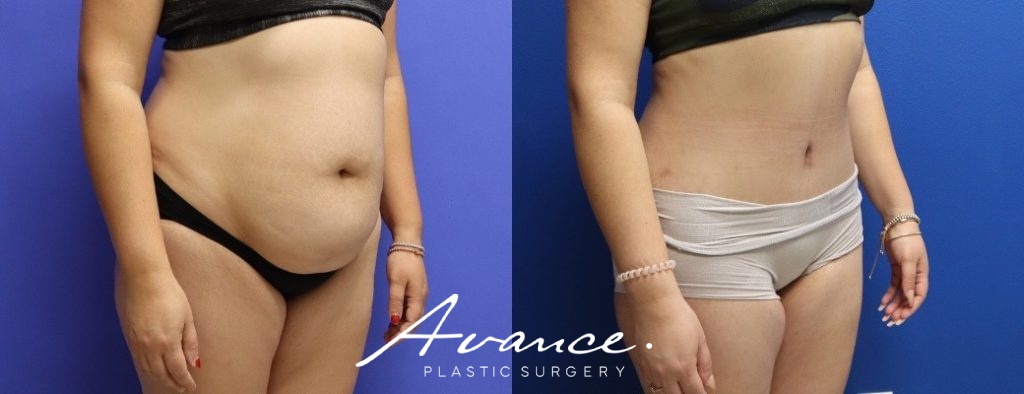 Before and After - Abdominoplasty
