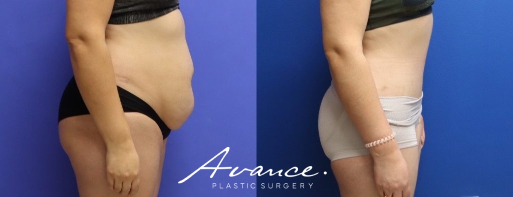 Before and After - Abdominoplasty