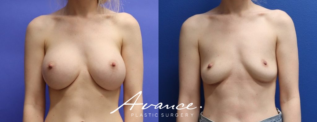 Before and After - Breast Implant Removal