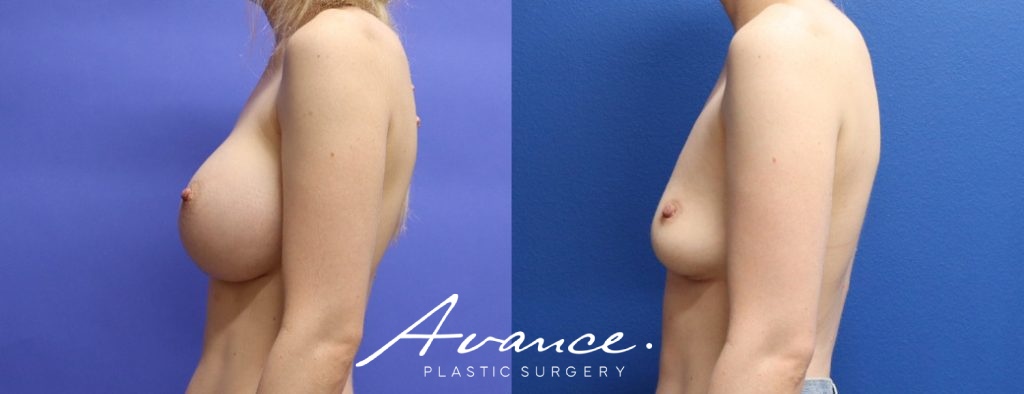 Before and After - Breast Implant Removal