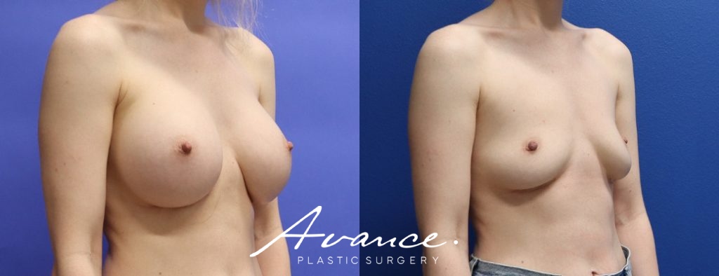 Before and After - Breast Implant Removal