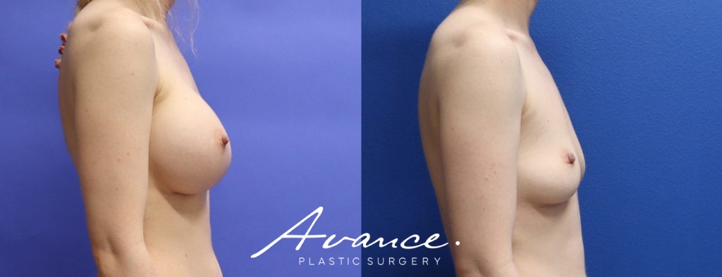 Before and After - Breast Implant Removal