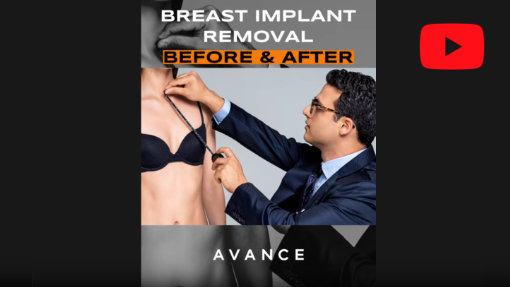YouTube video titled Breast Implant Removal Reno/Tahoe- Dr. Erez Dayan