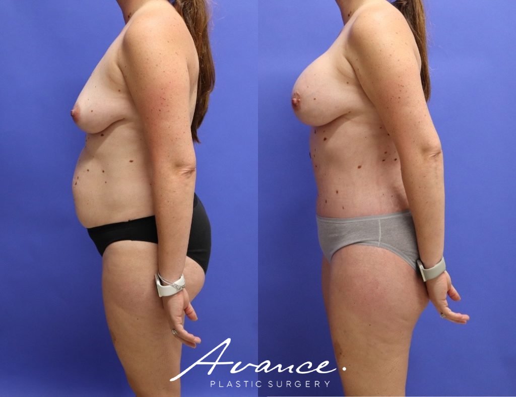 Before and After - Mommy Makeover
