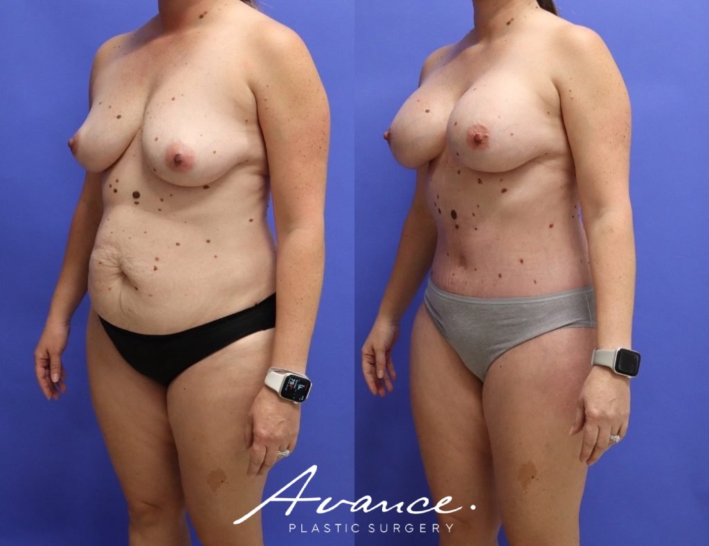 Before and After - Mommy Makeover