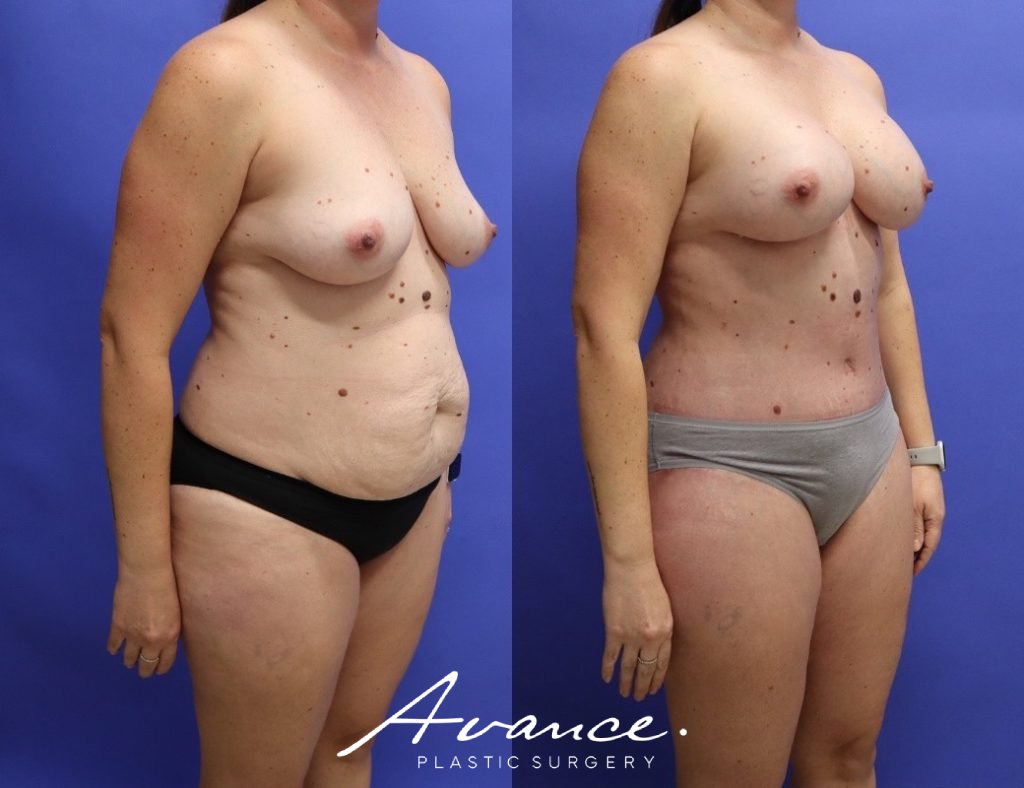 Before and After - Mommy Makeover