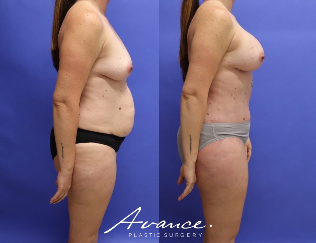 Before and After - Mommy Makeover
