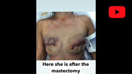Video de YouTube titulado Reconstrucción mamaria después de una mastectomía doble Reno NV | Cirugía Plástica Avance Dr. Erez Dayan