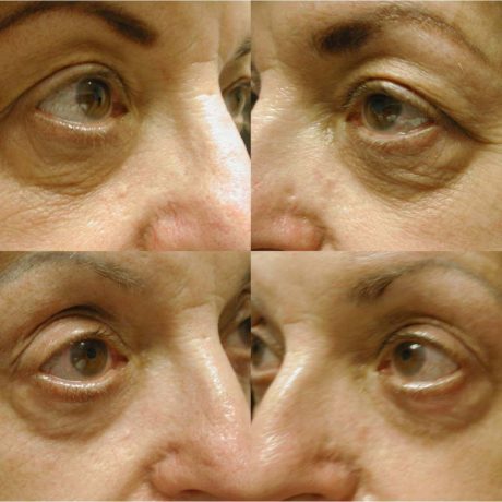 Before and After - Laser Resurfacing