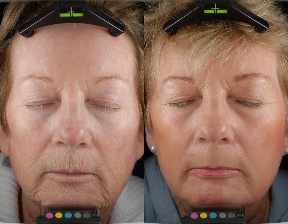 Before and After - Laser Resurfacing