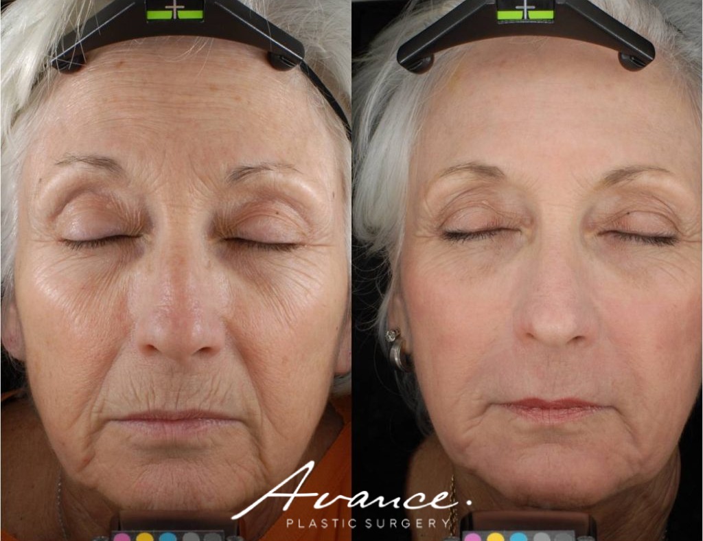 Before and After - Laser Resurfacing