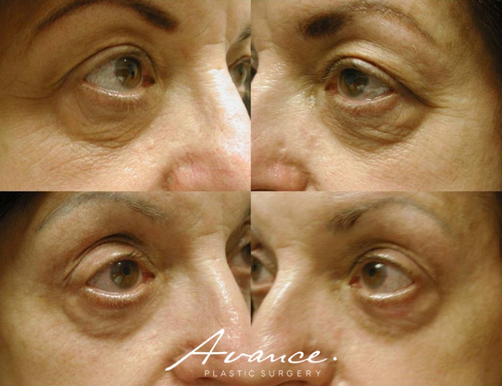 Before and After - Laser Resurfacing