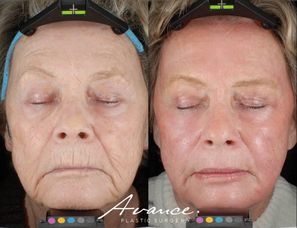 Before and After - Laser Resurfacing