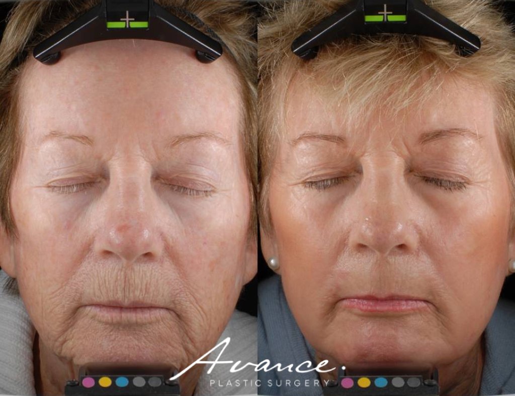 Before and After - Laser Resurfacing