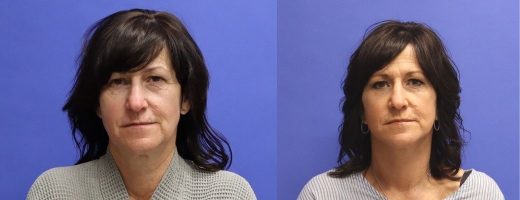 Before and After - Mini Face/Necklift