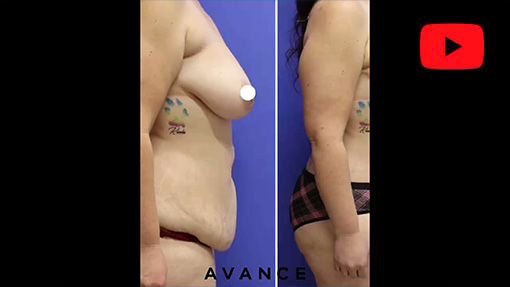 YouTube video titled Reno/Tahoe Mommy Makeover | Breast Lift, Abdominoplasty (Tummy Tuck), Liposuction | Dr. Erez Dayan