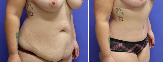 Before and After - Abdominoplasty