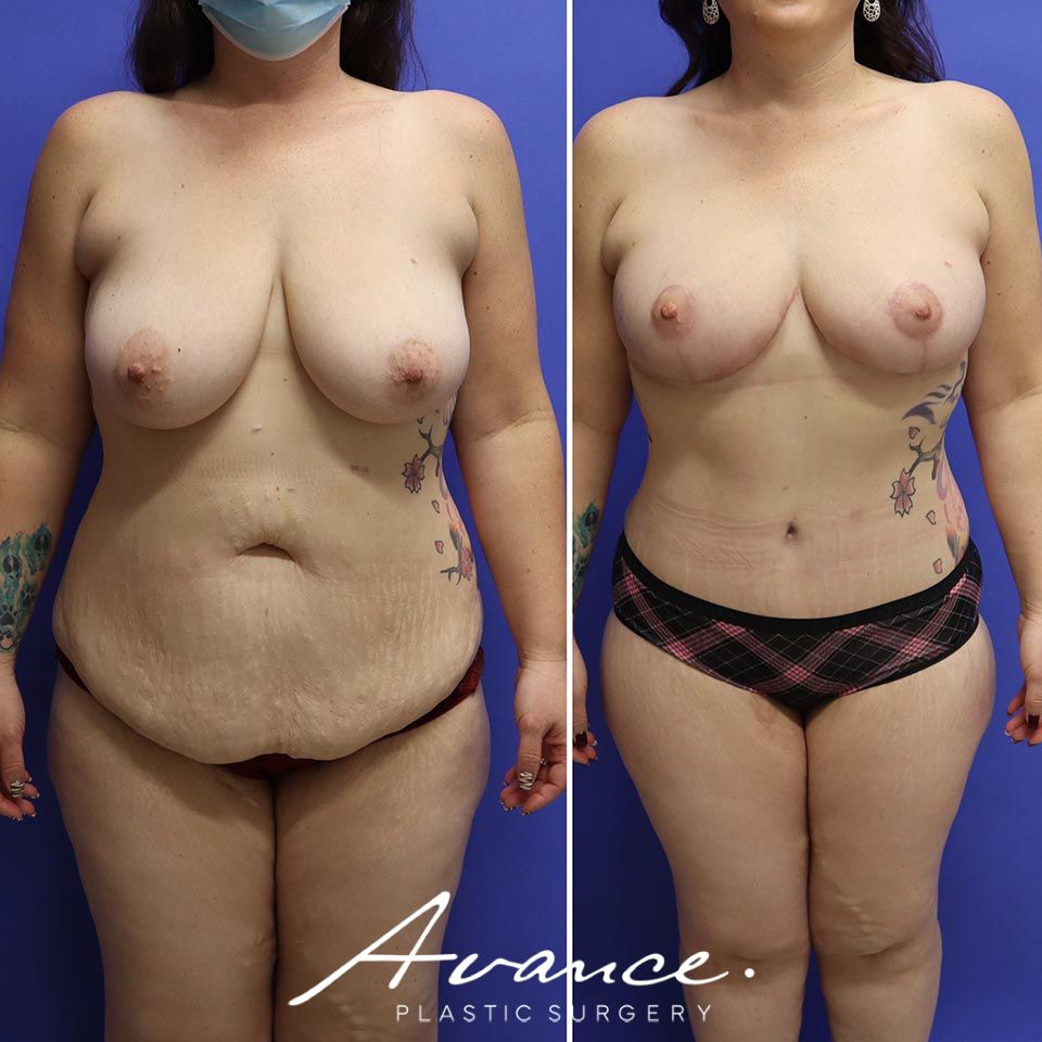 Before and After - Abdominoplasty