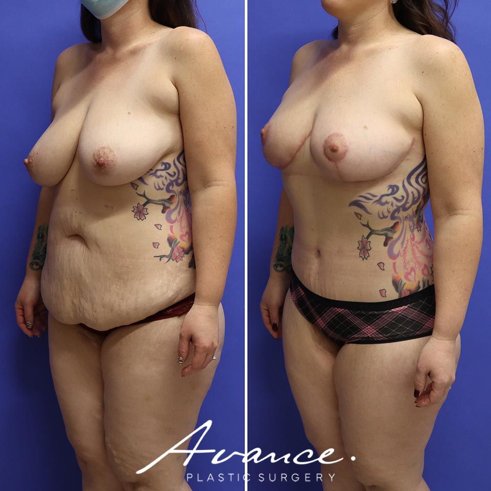 Before and After - Abdominoplasty