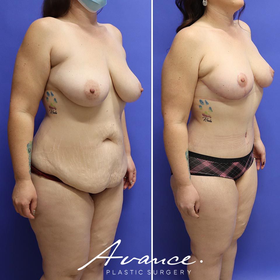 Before and After - Abdominoplasty