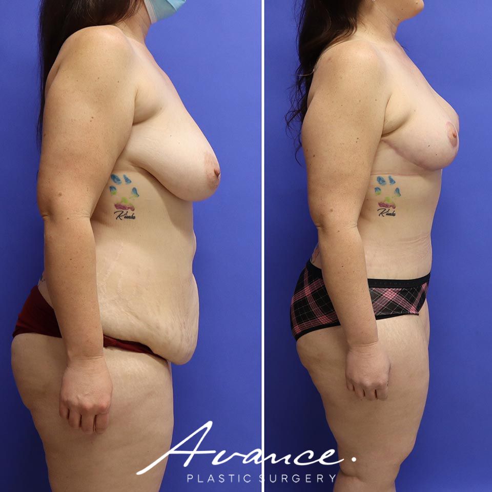Before and After - Abdominoplasty