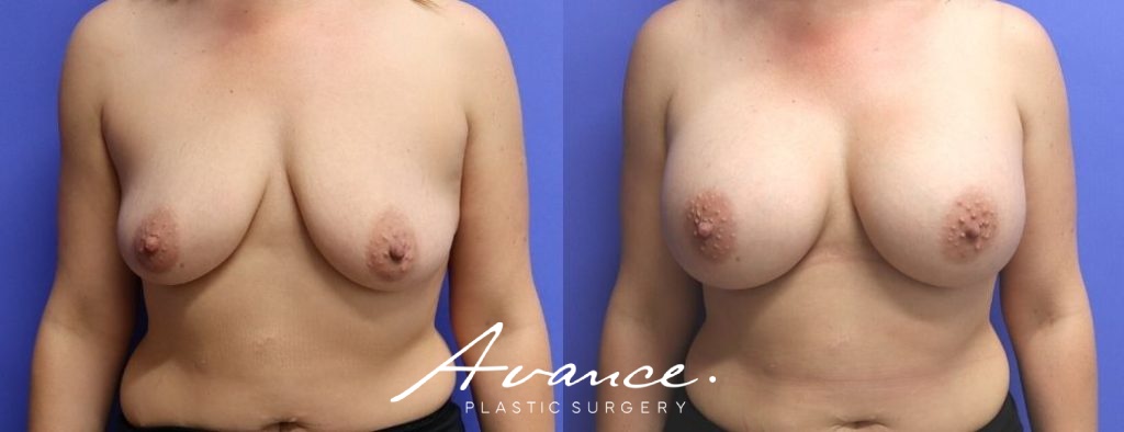 Before and After - Breast Augmentation
