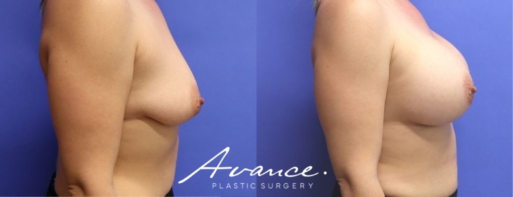 Before and After - Breast Augmentation