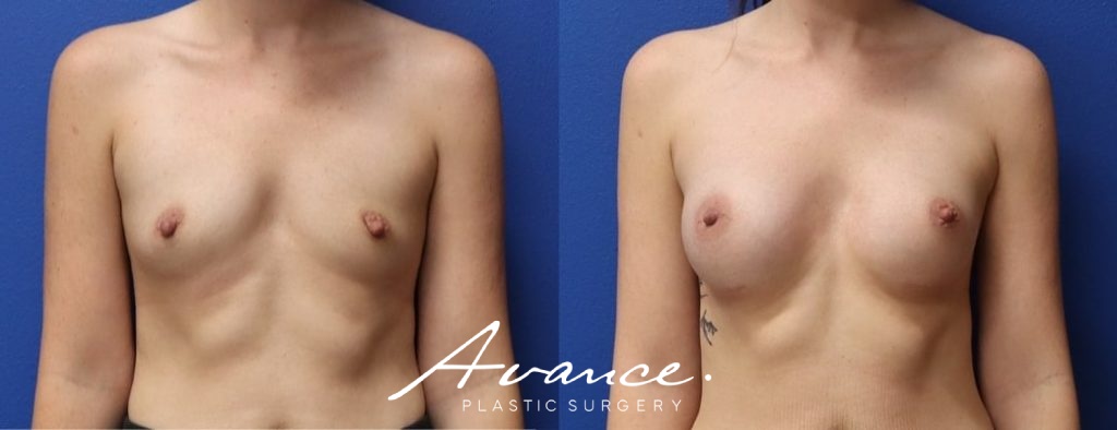 Before and After - Breast Augmentation