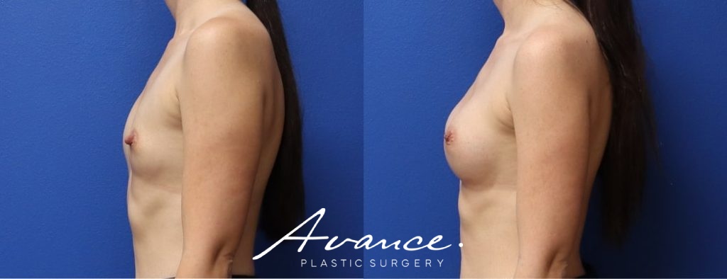 Before and After - Breast Augmentation