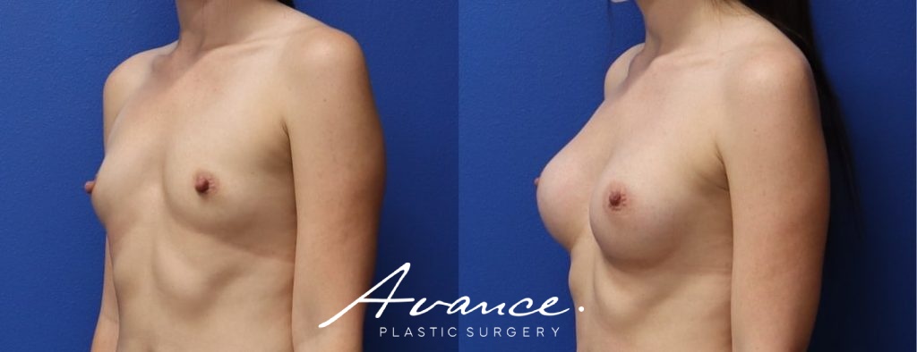 Before and After - Breast Augmentation