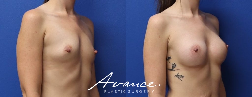 Before and After - Breast Augmentation