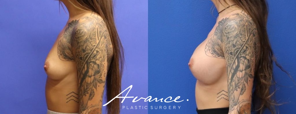 Before and After - Breast Augmentation