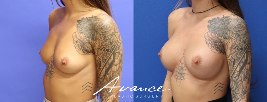 Before and After - Breast Augmentation
