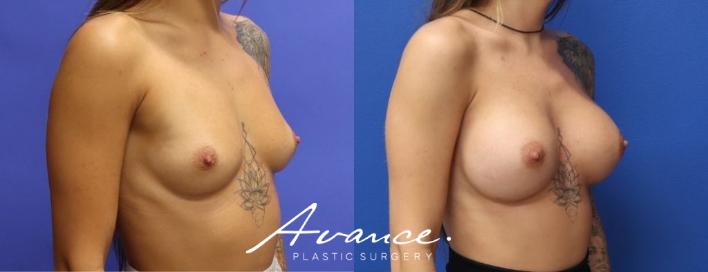 Before and After - Breast Augmentation