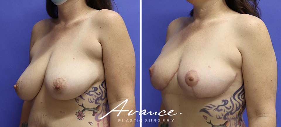Before and After - Breast Lift
