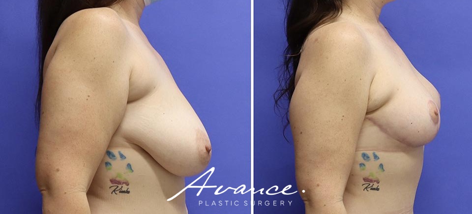 Before and After - Breast Lift