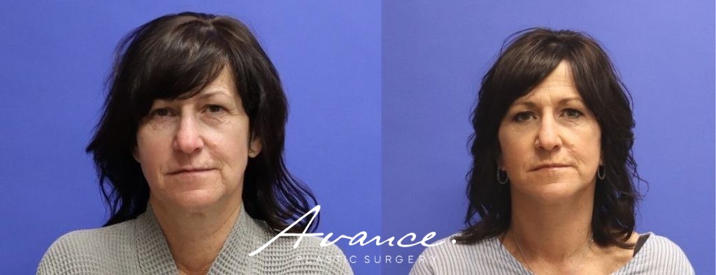 Before and After - Facelift/Necklift & Minifacelift/Necklift