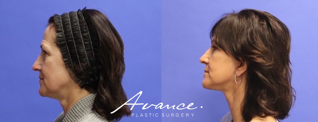Before and After - Facelift/Necklift & Minifacelift/Necklift