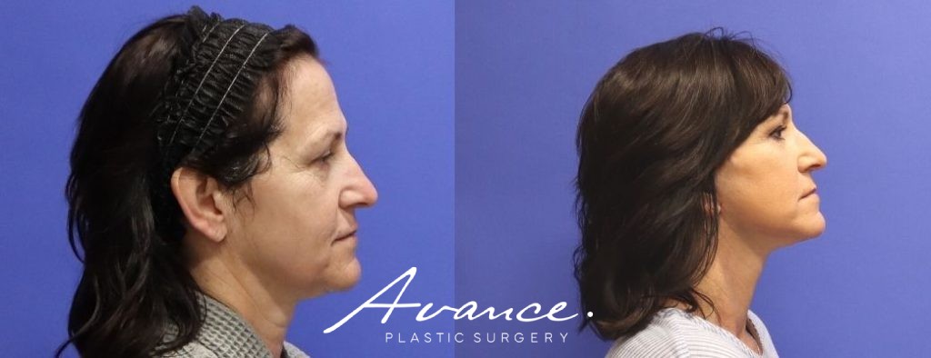 Before and After - Facelift/Necklift & Minifacelift/Necklift