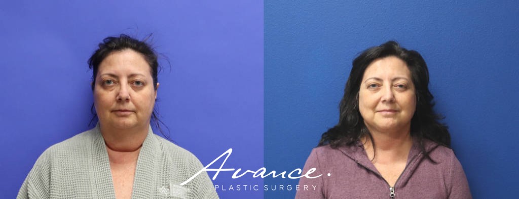Before and After - Mini Face/Necklift