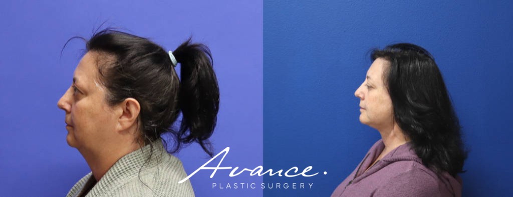 Before and After - Mini Face/Necklift