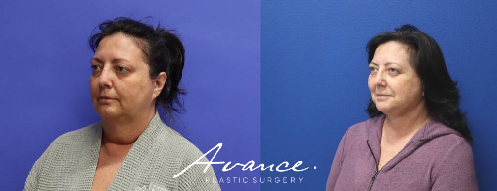 Before and After - Mini Face/Necklift