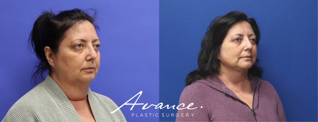 Before and After - Mini Face/Necklift