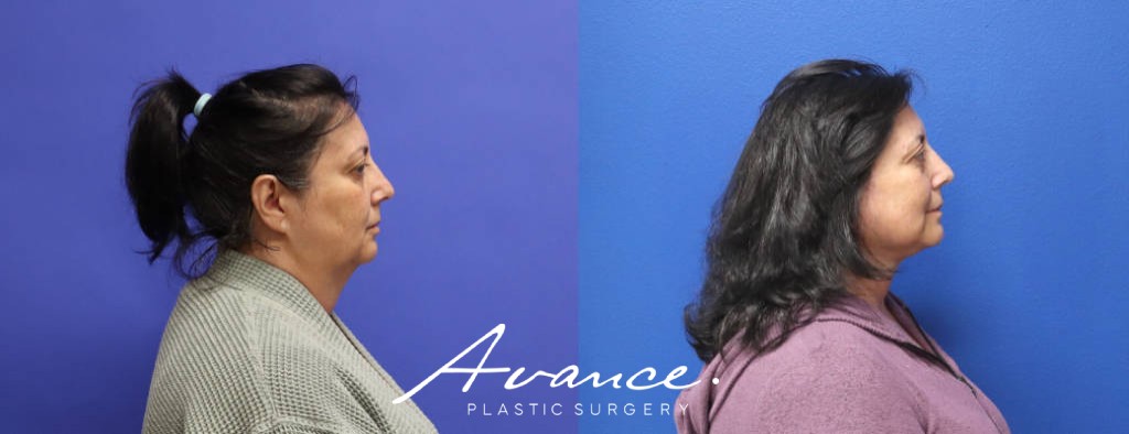 Before and After - Mini Face/Necklift