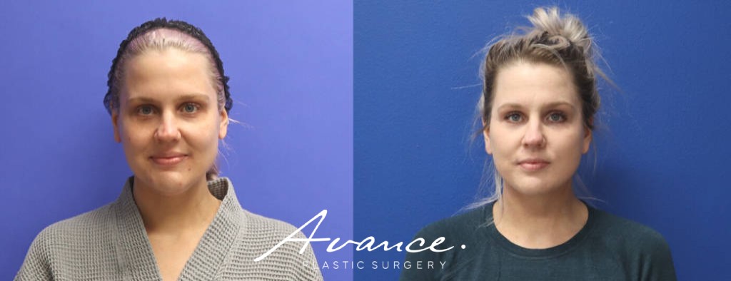 Before and After - Facelift/Necklift & Minifacelift/Necklift