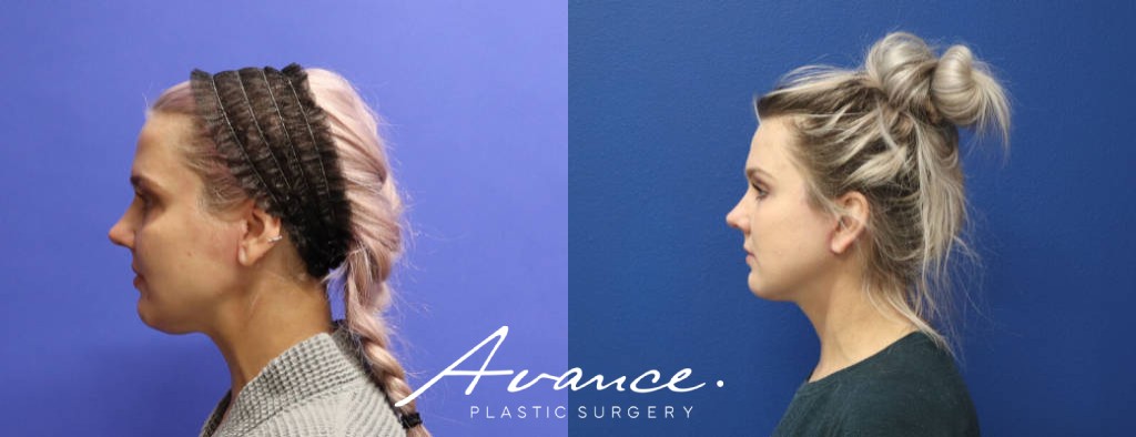 Before and After - Facelift/Necklift & Minifacelift/Necklift