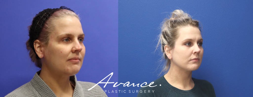 Before and After - Facelift/Necklift & Minifacelift/Necklift