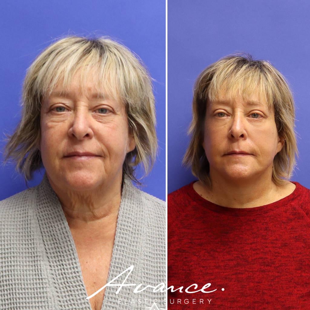 Before and After - Facelift/Necklift & Minifacelift/Necklift